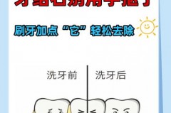 冲牙器牙结石能洗掉吗，冲牙器可以洗掉牙结石么？