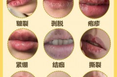 女性为什么会得口唇疱疹，嘴唇老是长疱疹怎么回事啊，为什么嘴唇总长疱疹？