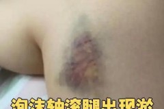 泡沫轴滚腿出现淤青正常吗_泡沫轴滚腿会肿吗
