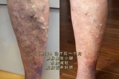 静脉曲张袜白天晚上都要穿吗，静脉曲张袜白天可以一直穿着吗？