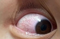 戴隐形眼镜眼底充血是什么原因造成的，戴隐形眼镜时眼睛充血？