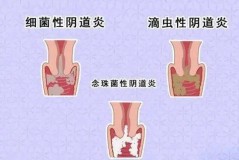 为什么内裤像火烧一样烂了，内裤为什么会有烧焦的感觉