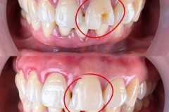 补完牙牙线进不去正常吗_补完牙后牙线进不去