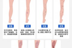 压力袜是什么袜子，压力袜好不好？