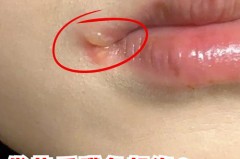 感冒了嘴唇疱疹怎么办，感冒了为什么嘴唇起泡，感冒后嘴唇上长泡？