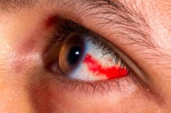 戴隐形眼镜眼底充血是什么原因造成的_戴隐形眼镜导致眼睛充血